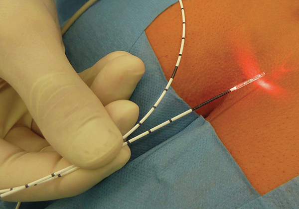 Αναίμακτη χειρουργική κύστης κόκκυγος με Laser